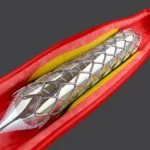 القسطرة القلبية